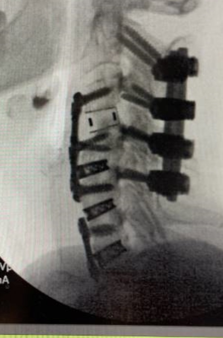 Danielle's spinal X-ray showing the hardware from her spine surgery